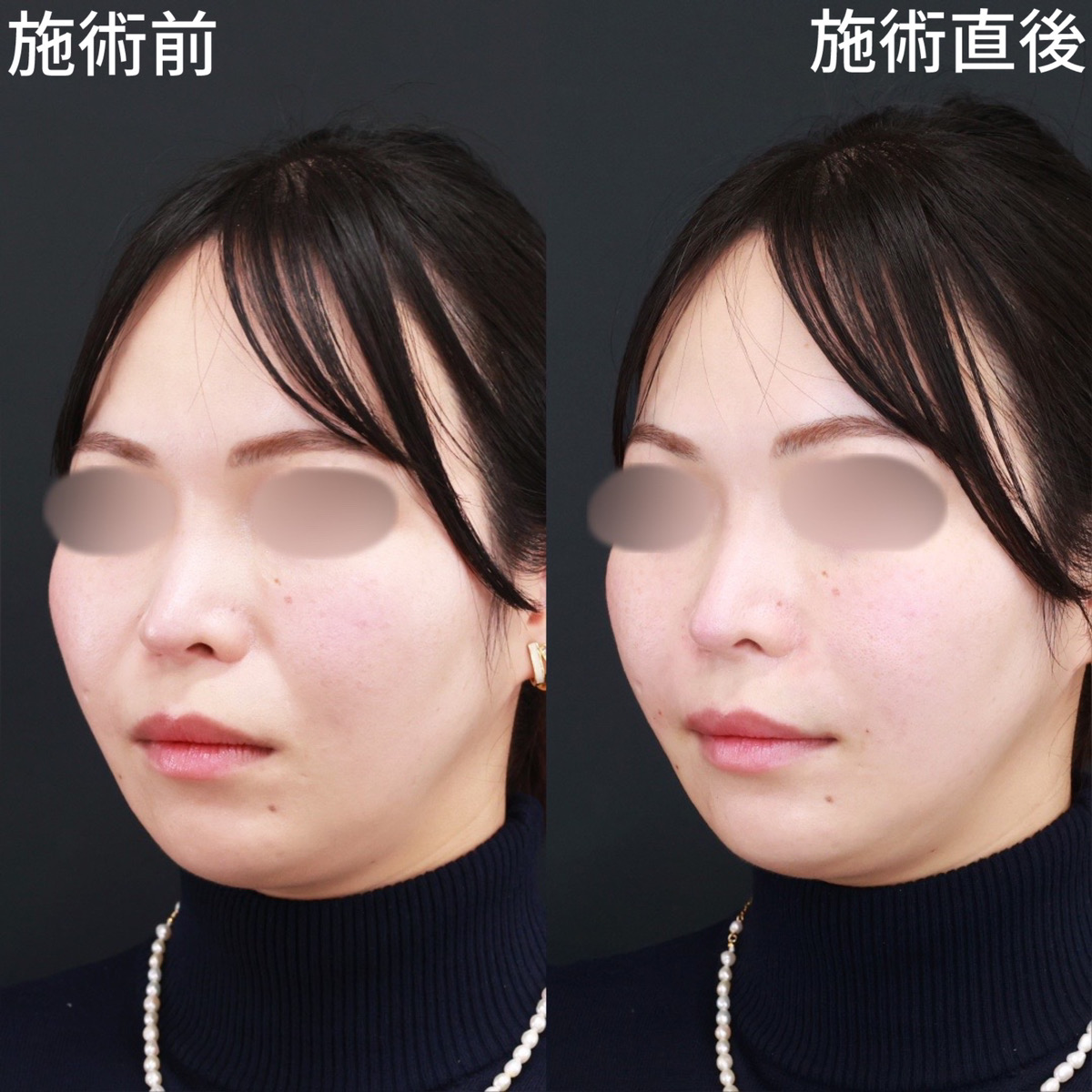 ほうれい線のヒアルロン酸注射/ヒアルロン酸注射：その他の症例写真 施術前後 