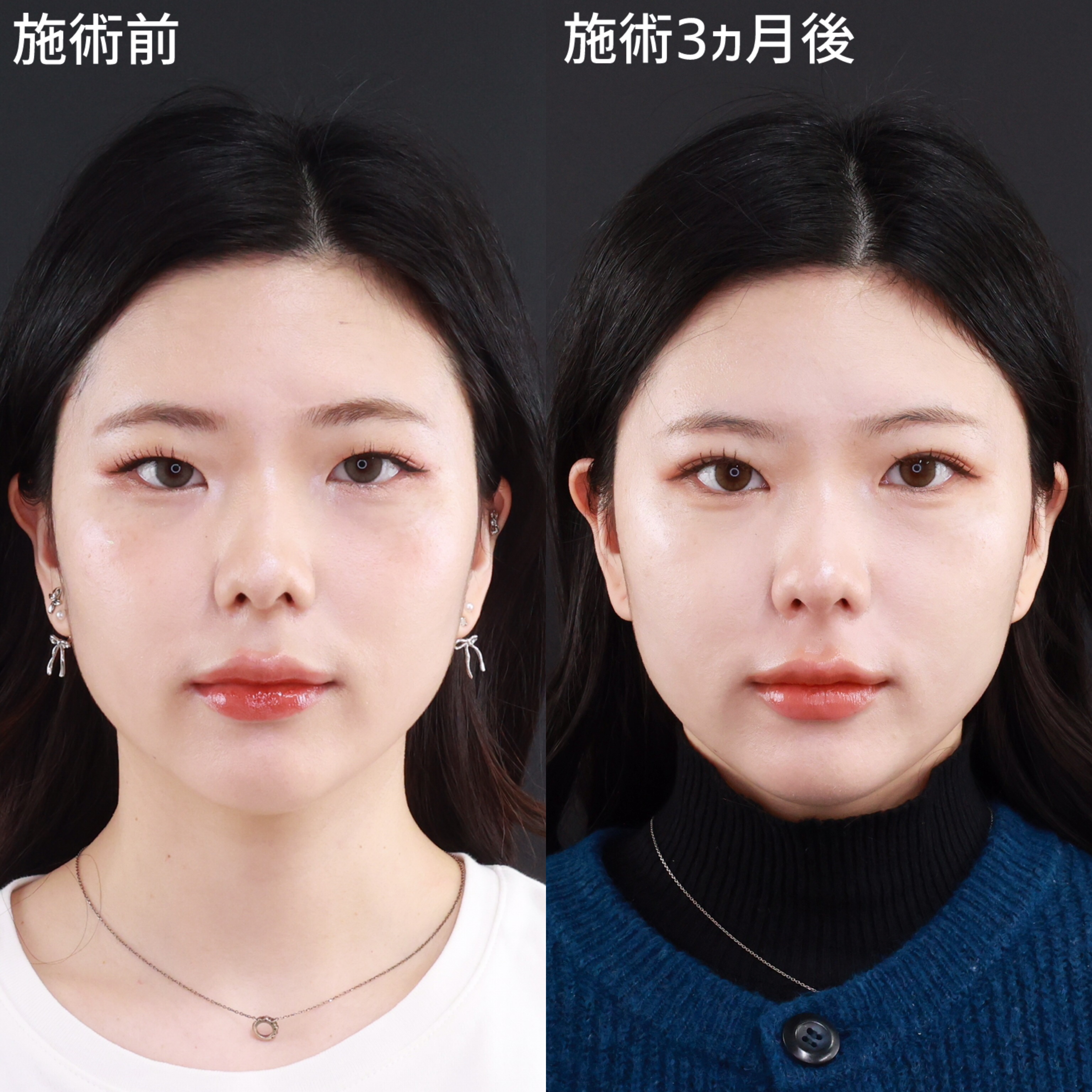 二重埋没法/目頭切開術/目元：その他の症例写真 施術前後 