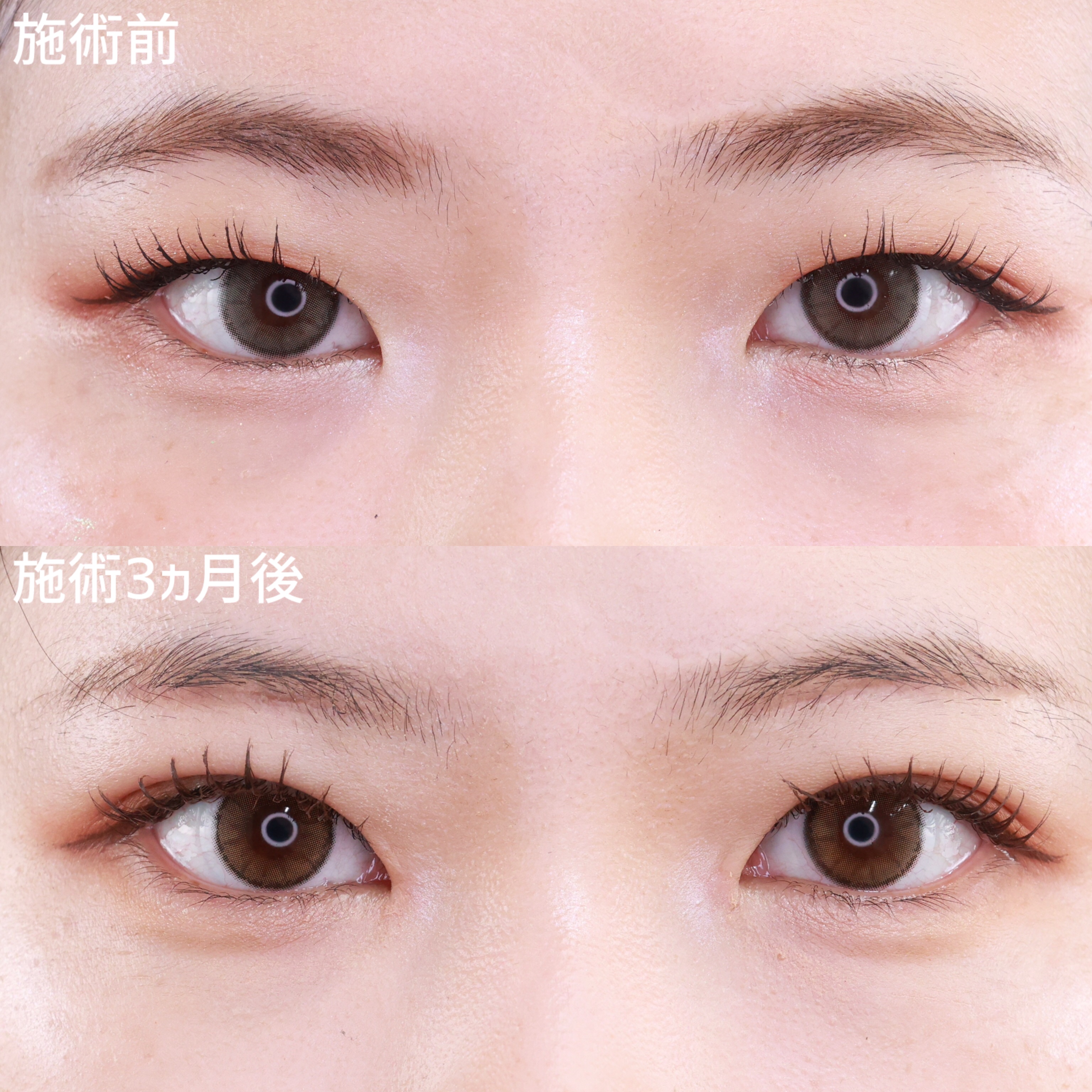 上眼瞼切開術 ダウンタイム 20代の症例写真・画像・ビフォー
