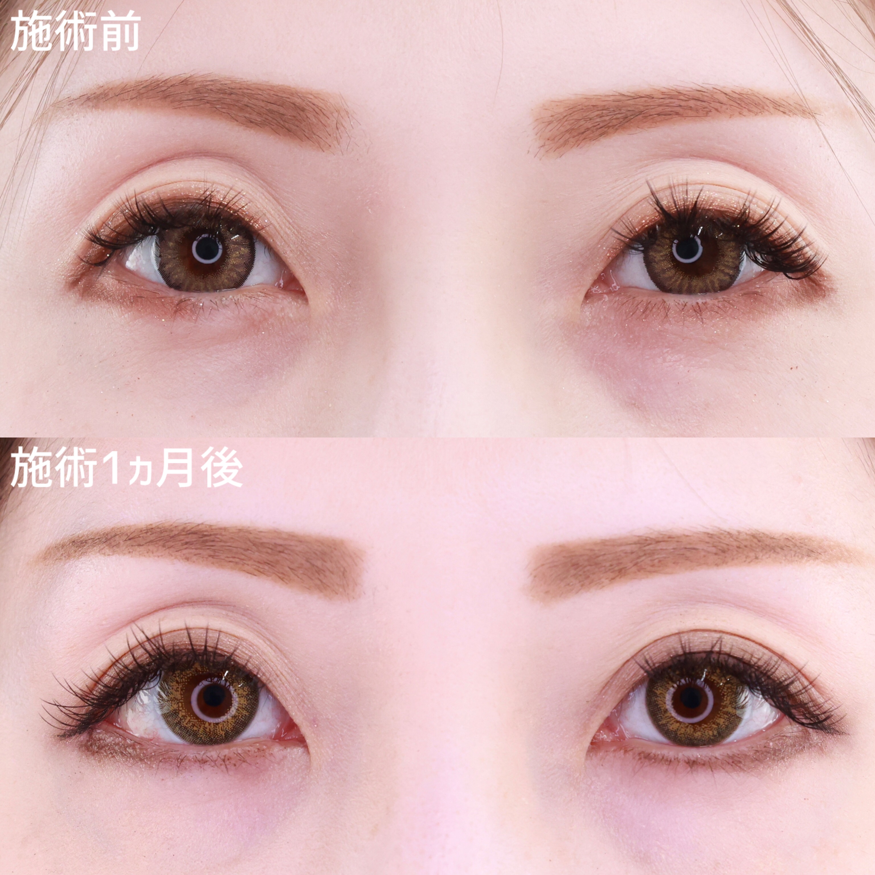 目尻切開術/目尻靭帯移動術の症例写真 施術前後