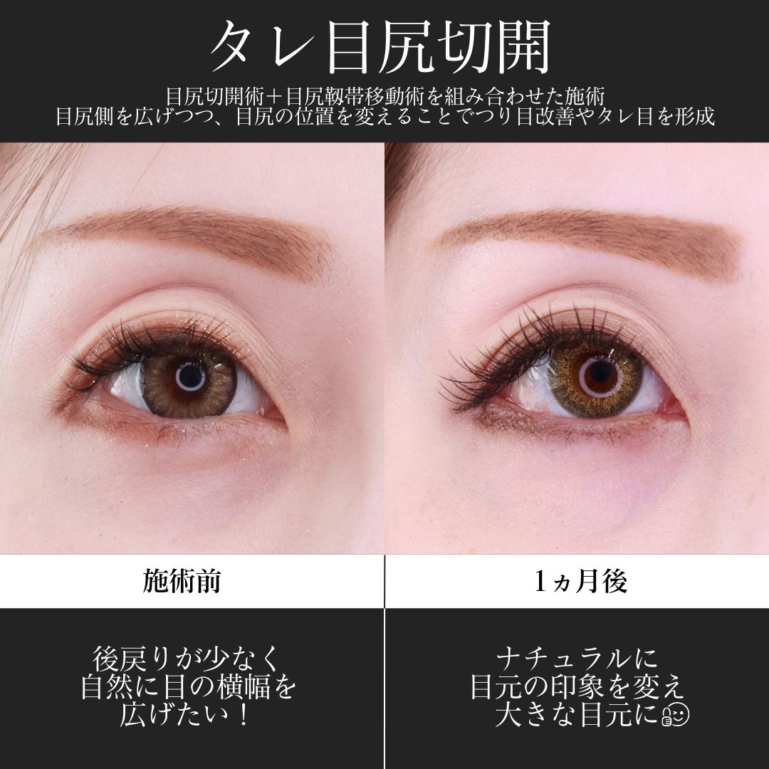 目尻切開術/目尻靭帯移動術の症例写真 施術前後