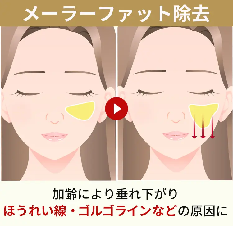 メーラーファットとは