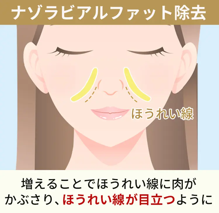 ナゾラビアルファットとは