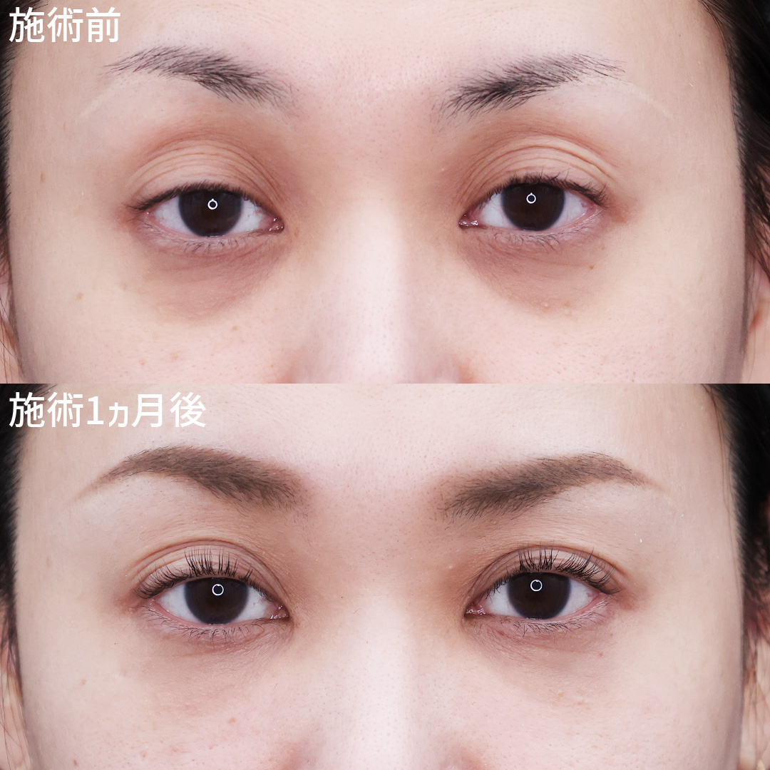 クマ改善で、明るく健康的なお目元に