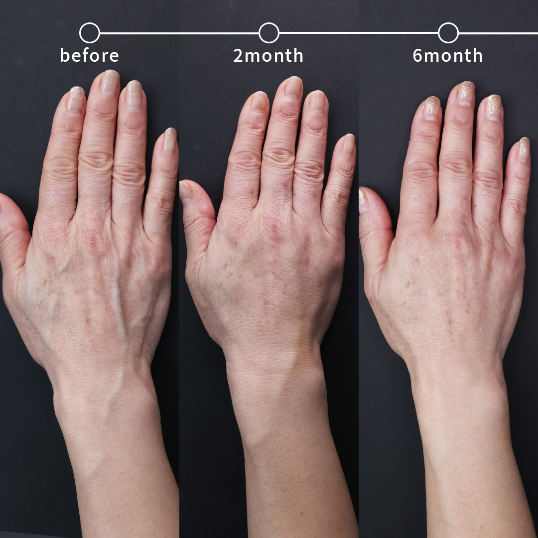 ハンドベイン（手のアンチエイジング・血管治療）の症例写真 施術前後 