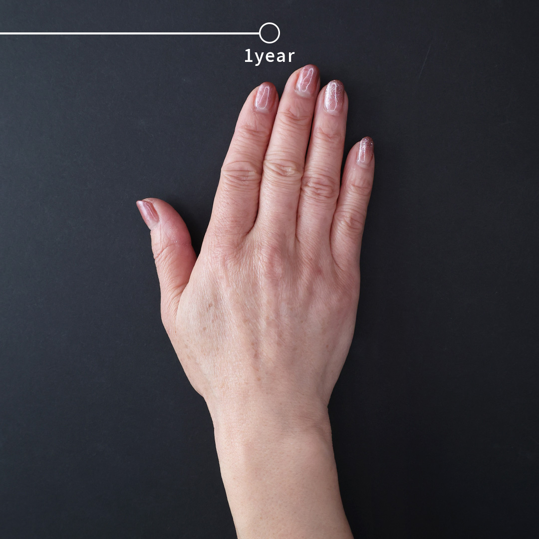 ハンドベイン（手のアンチエイジング・血管治療）の症例写真 施術前後 