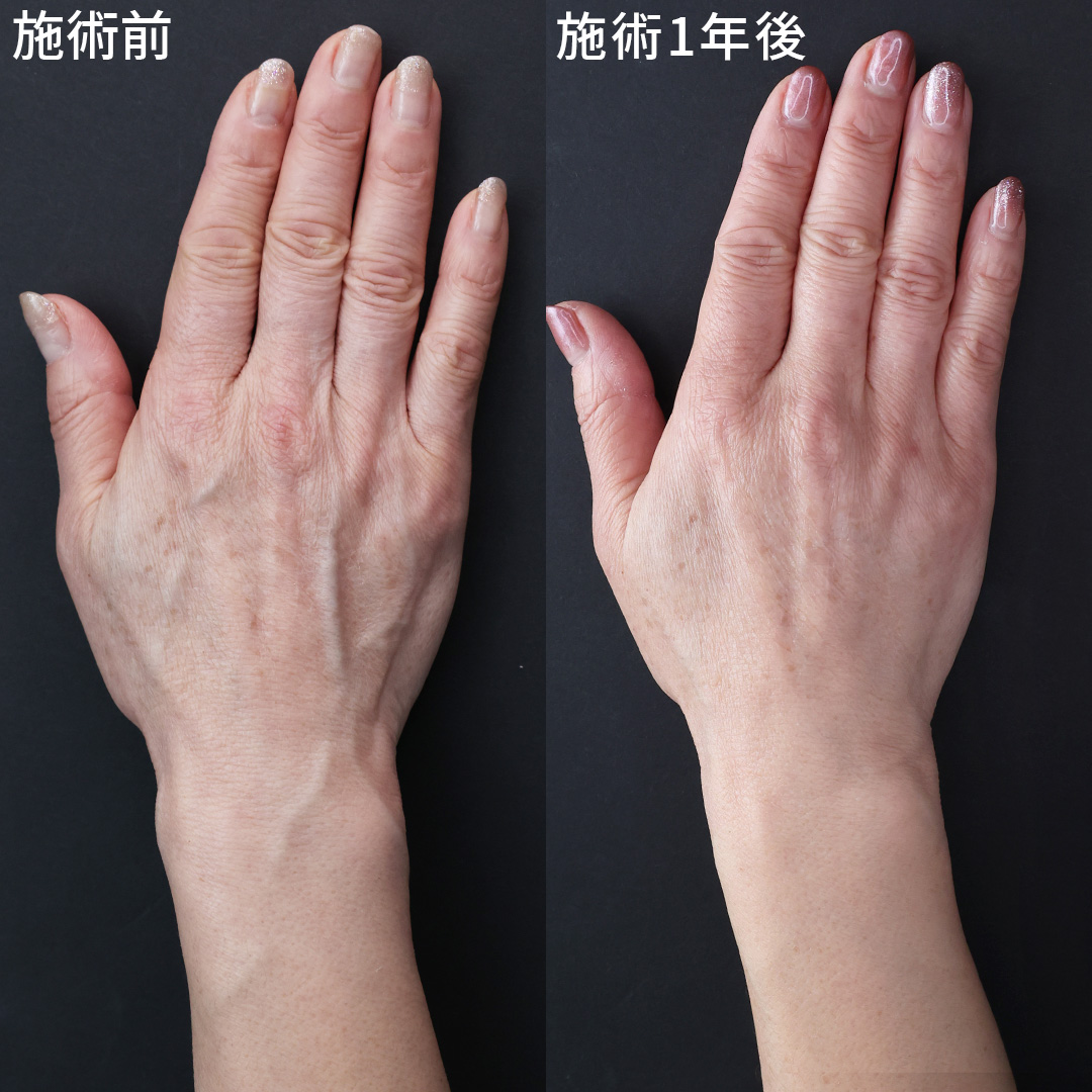 「老け手」の根本改善なら川越TAクリニックへ