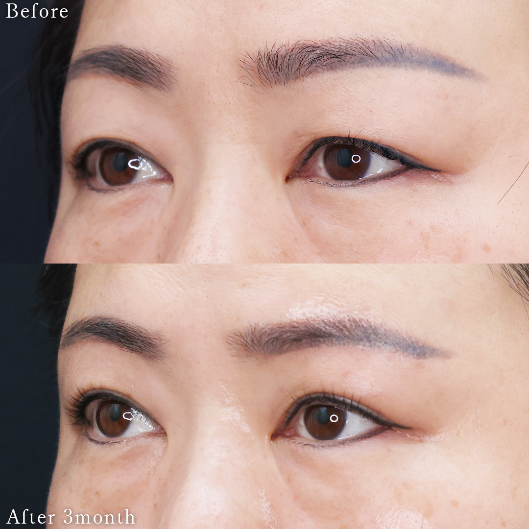 眉毛下切開術の症例写真 施術前後 