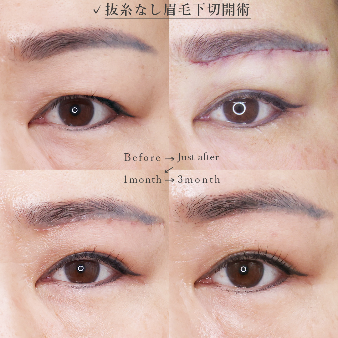 眉毛下切開術の症例写真 施術前後 