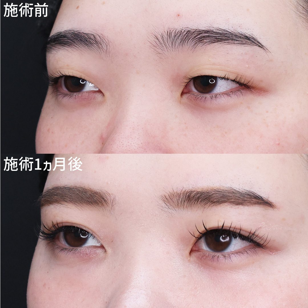 二重のりはもう要らない！【埋没法】で常に理想の二重