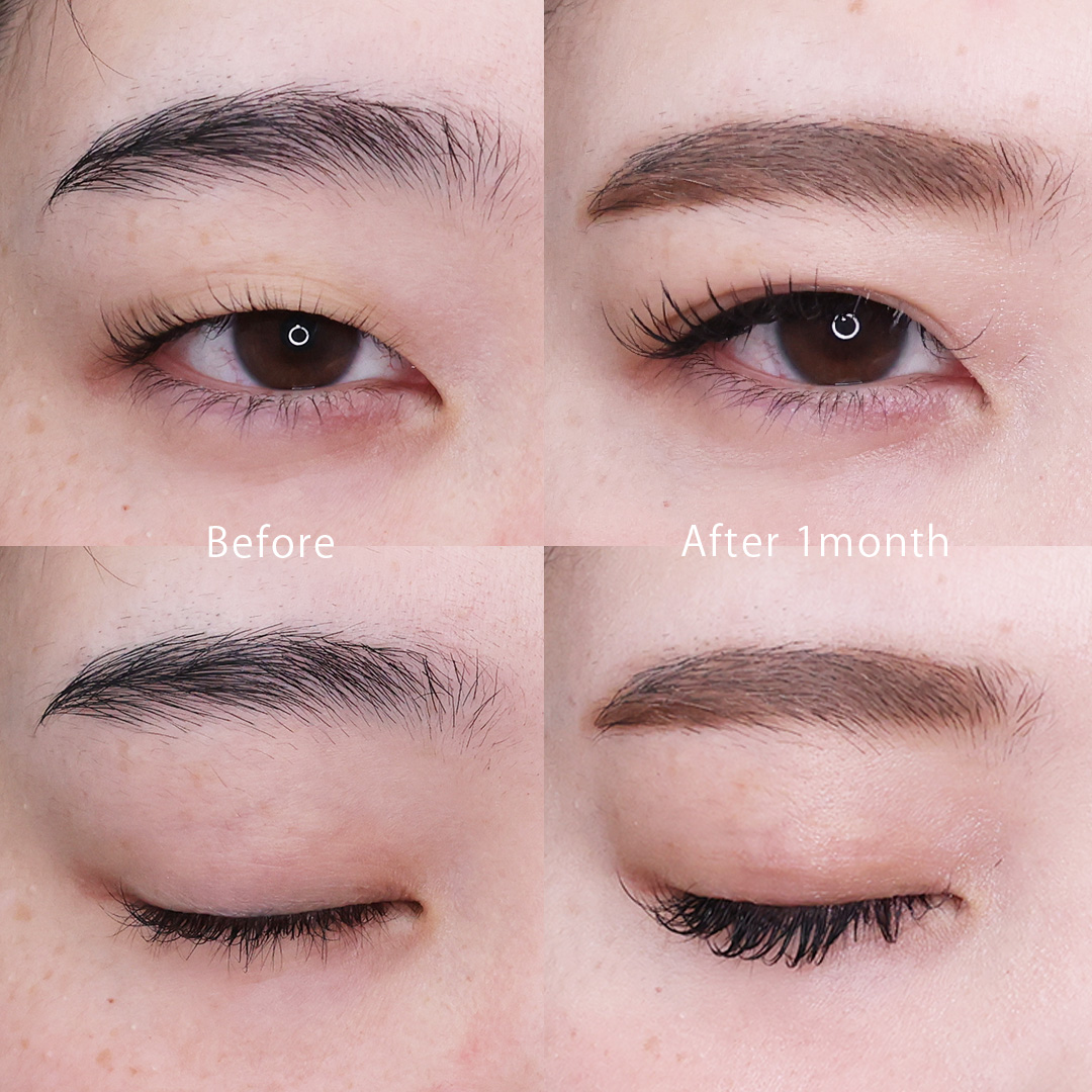 二重埋没法の症例写真 施術前後 