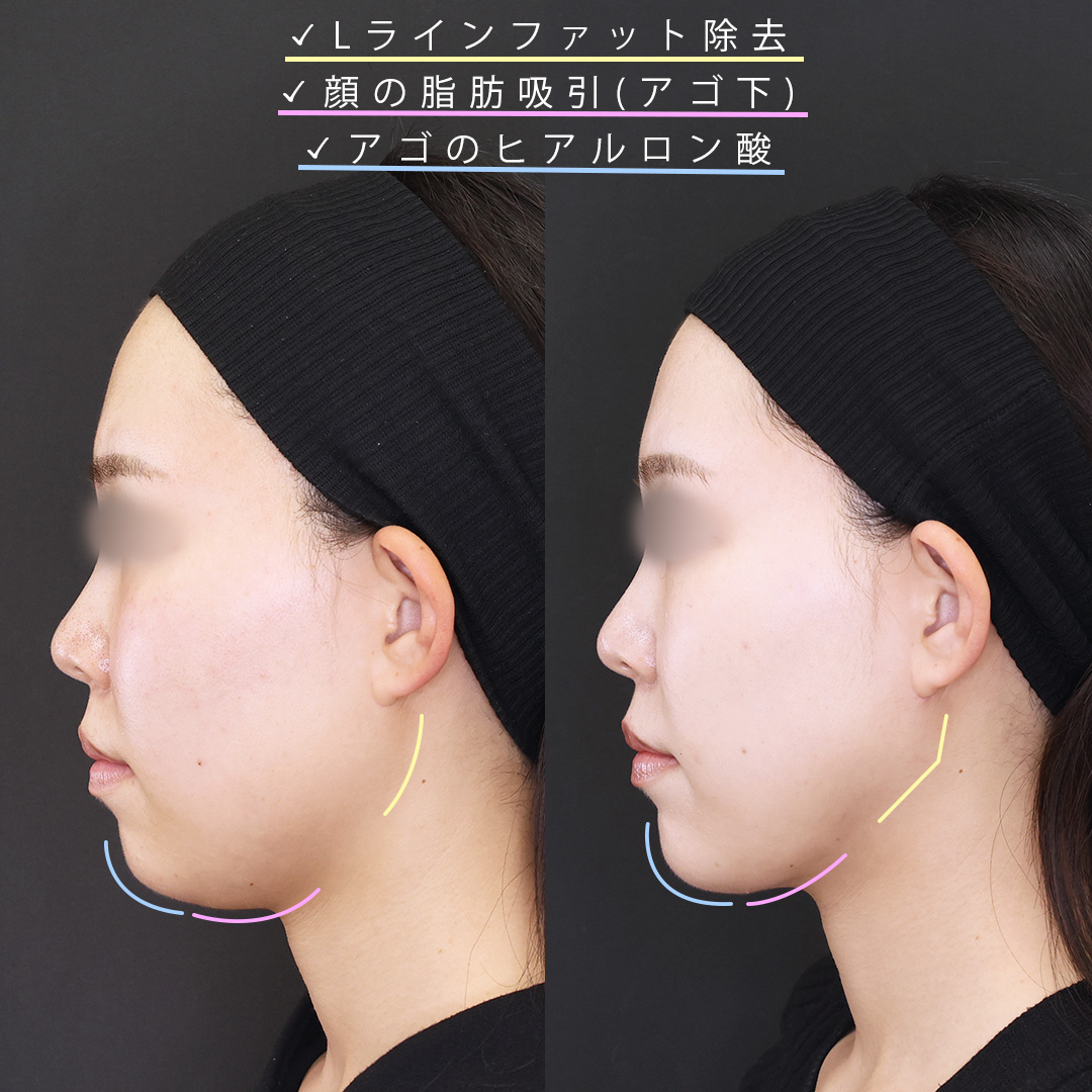 顔の脂肪吸引/Lラインファット除去（エラ下脂肪除去）/顎のヒアルロン酸注射の症例写真 施術前後 