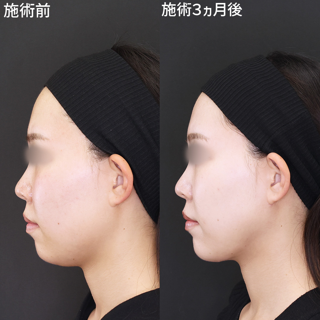 【脂肪吸引】でアゴ下のボリュームダウン！シャープに洗練◎