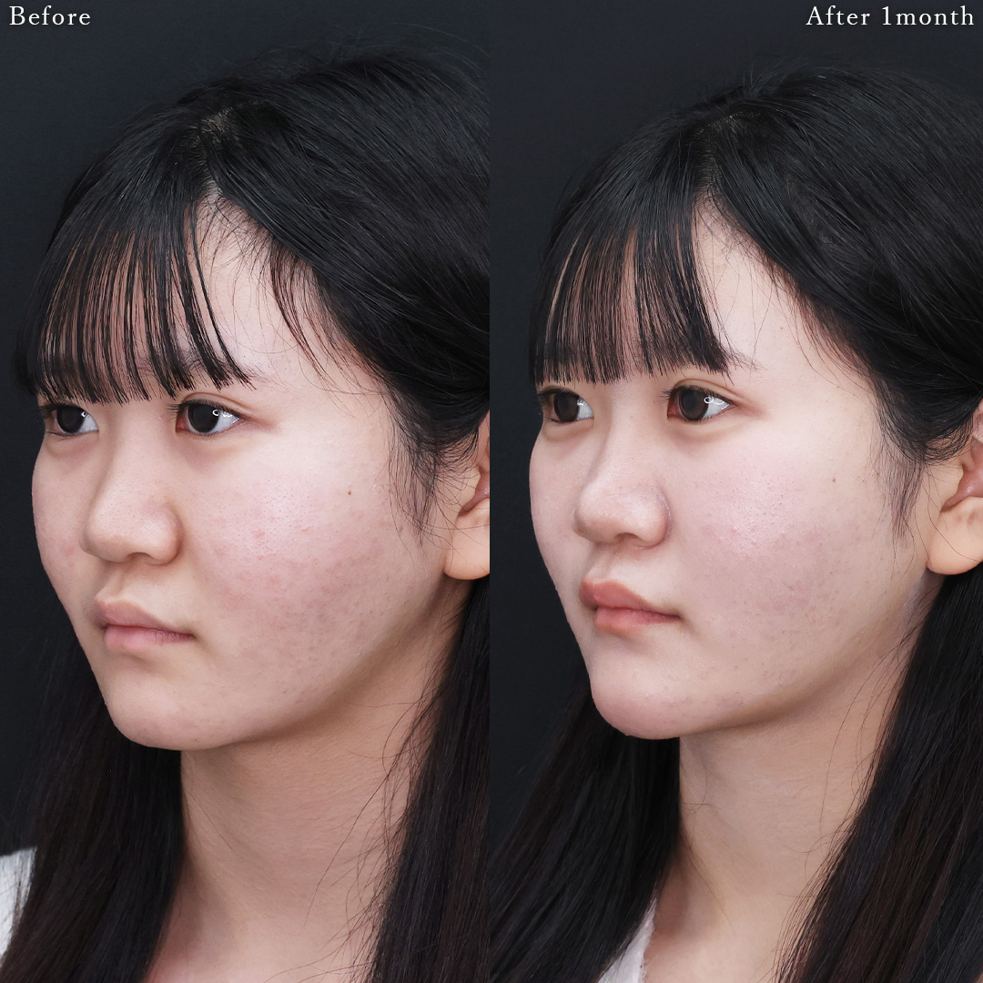 メーラーファット除去/顎のヒアルロン酸注射の症例写真 施術前後 