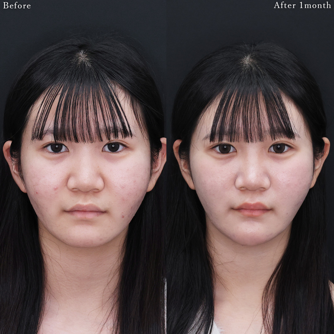 メーラーファット除去/顎のヒアルロン酸注射の症例写真 施術前後 