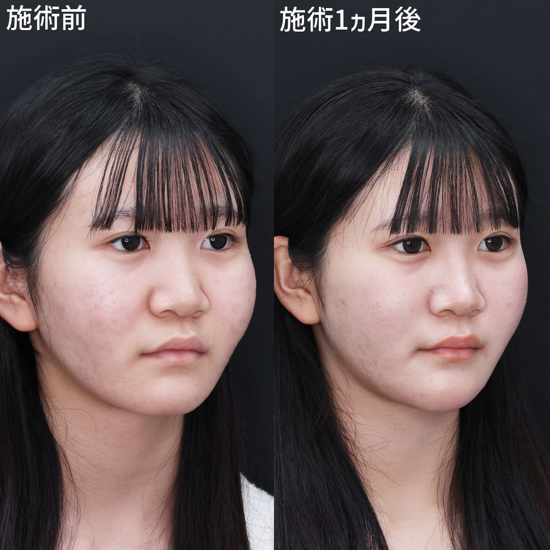 頬のボリュームを自然にダウン◎可愛らしさを残したまま垢抜け
