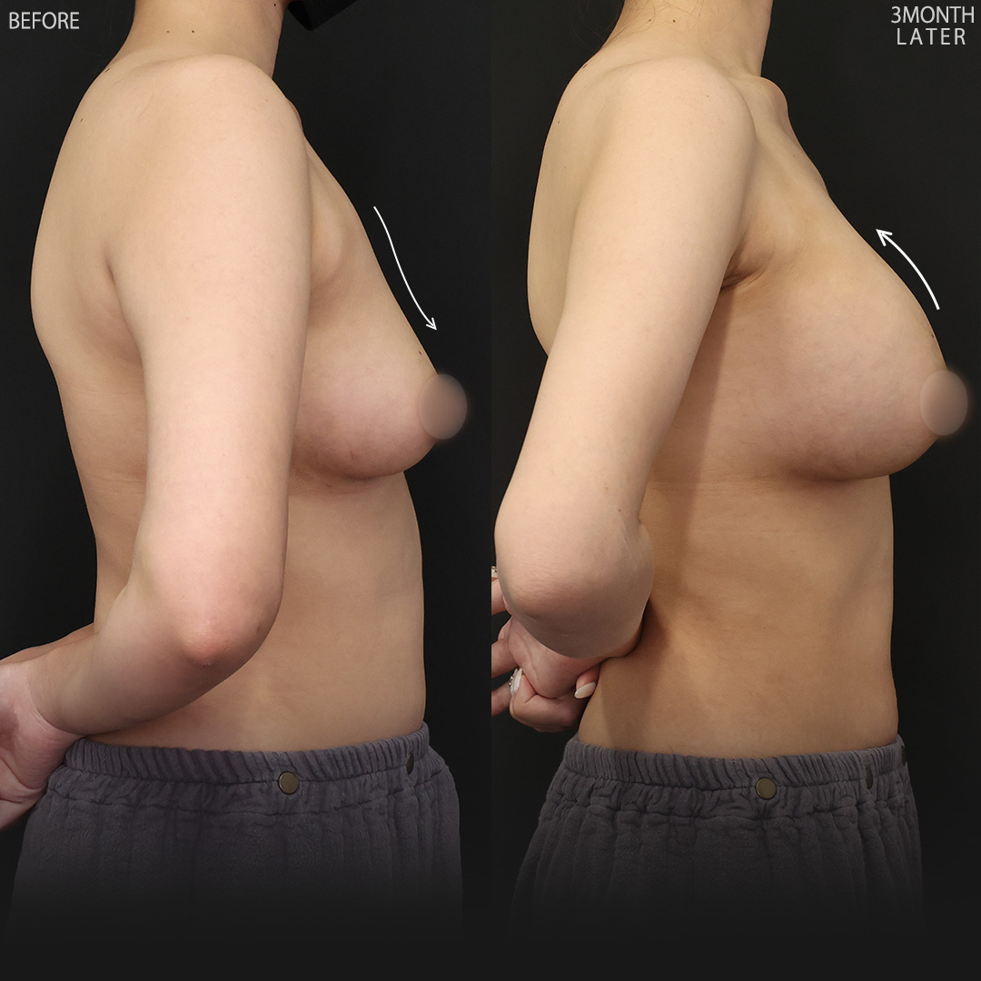 シリコンバッグ豊胸（人工乳腺バッグ）の症例写真 施術前後 