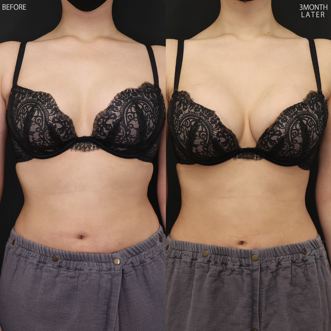 シリコンバッグ豊胸（人工乳腺バッグ）の症例写真 施術前後 