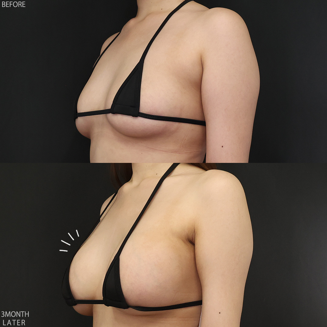 シリコンバッグ豊胸（人工乳腺バッグ）の症例写真 施術前後 