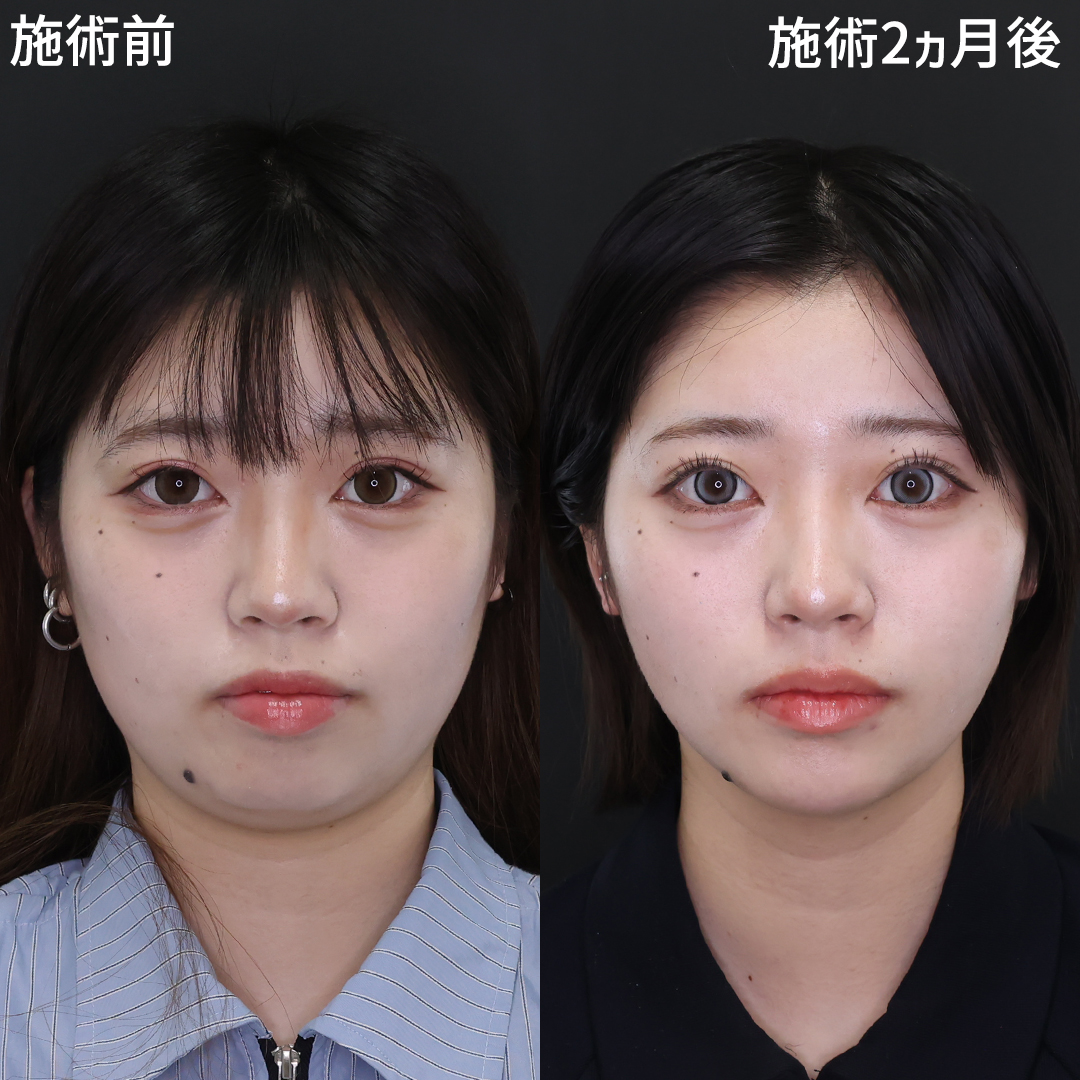 二十顎改善！自分に自信がもてる小顔整形