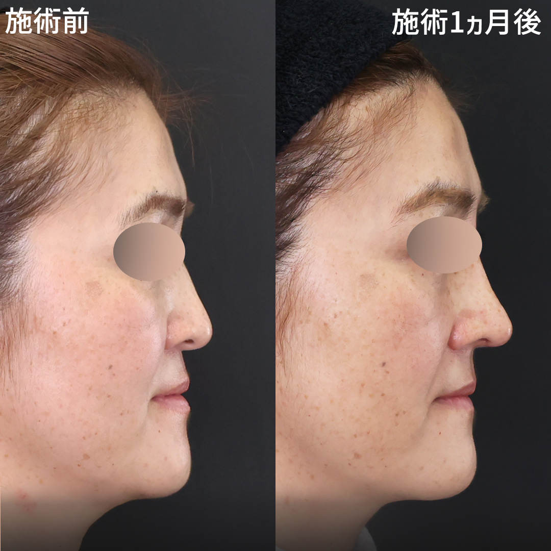 鼻整形で顎の突出感も改善！今日から、低い鼻は卒業！