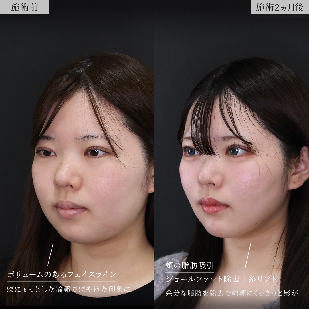 TAC式 ツヤ肌コラーゲンリフト®/ジョールファット除去/Lラインファット除去（エラ下脂肪除去）の症例写真 施術前後 