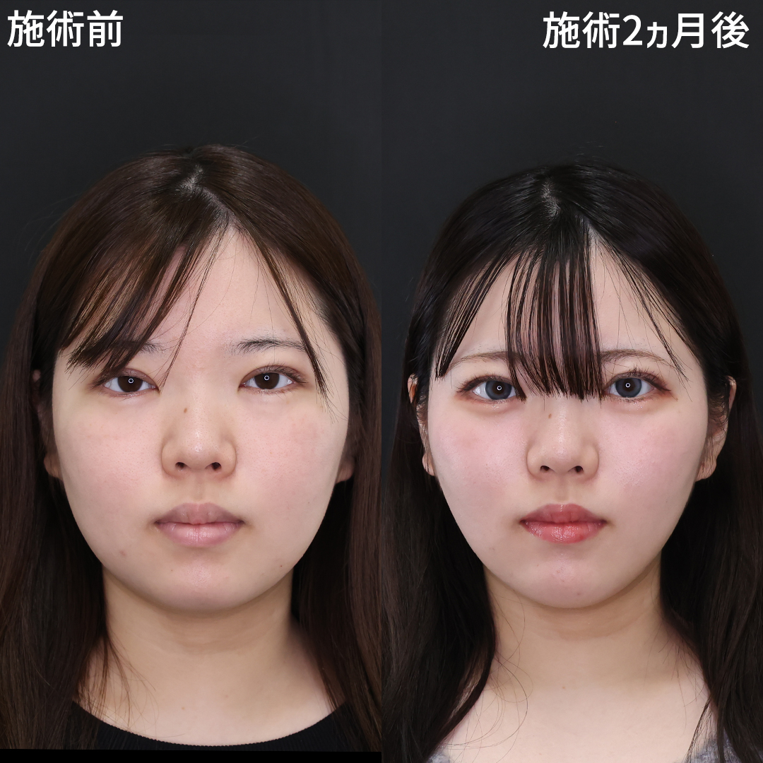 まだ小顔マッサージしてるの？垢抜け小顔整形