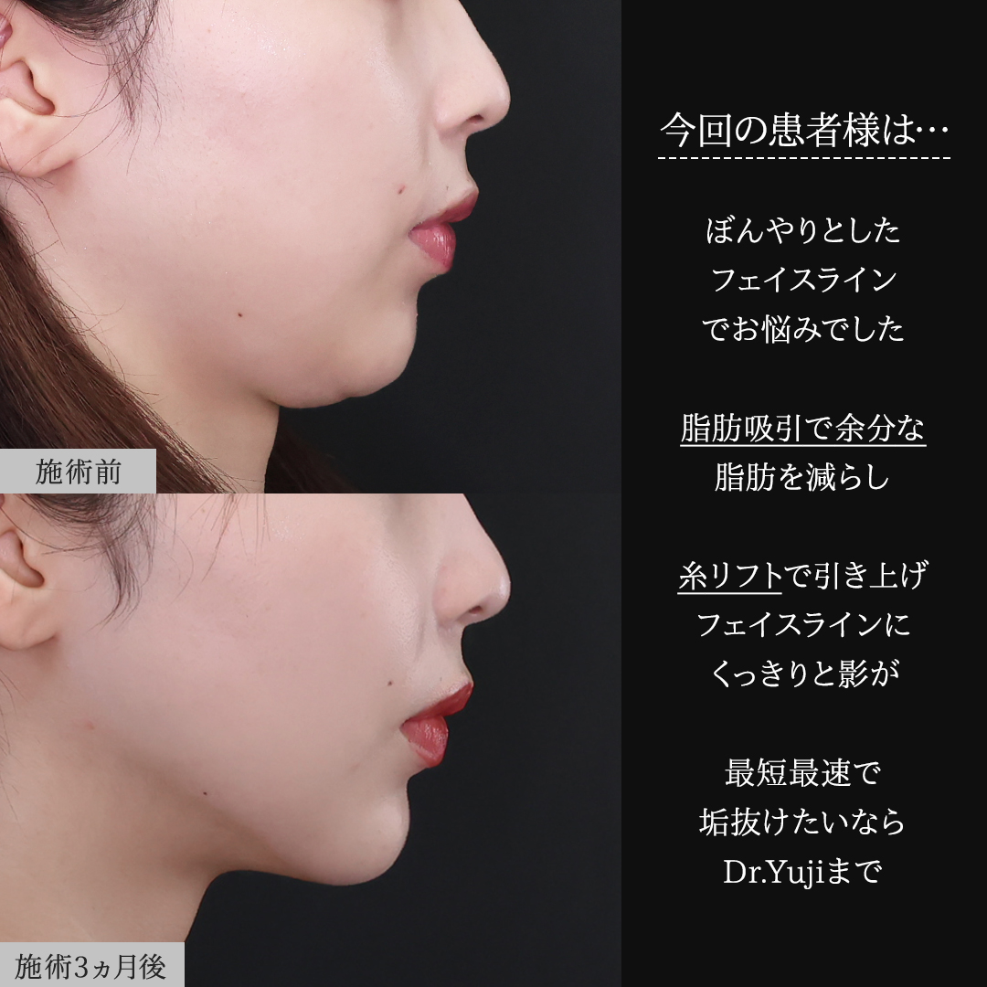 TAC式 ツヤ肌コラーゲンリフト®/顎下の脂肪吸引/ジョールファット除去の症例写真 施術前後 