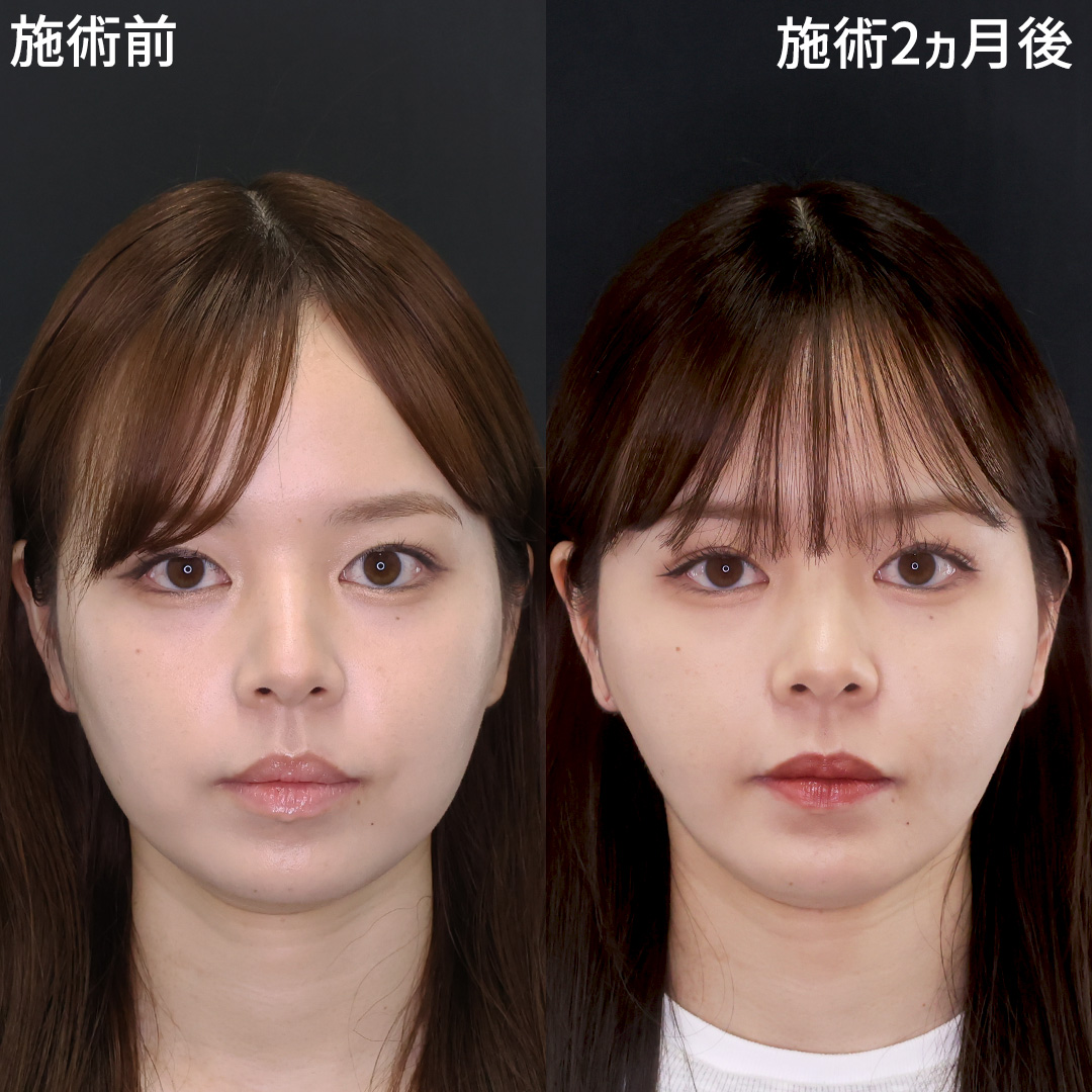 美少女から大人の女性へ。美女爆誕・小顔整形