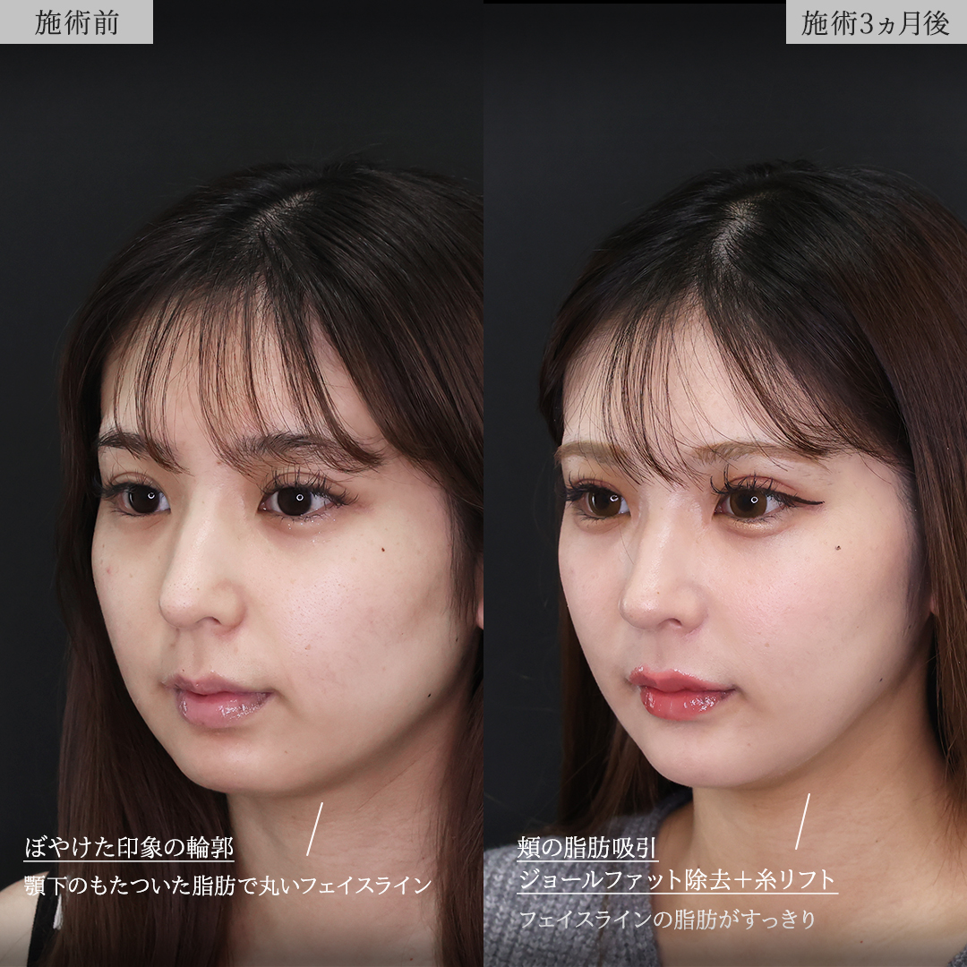 TAC式 ツヤ肌コラーゲンリフト®/顔の脂肪吸引/ジョールファット除去の症例写真 施術前後 