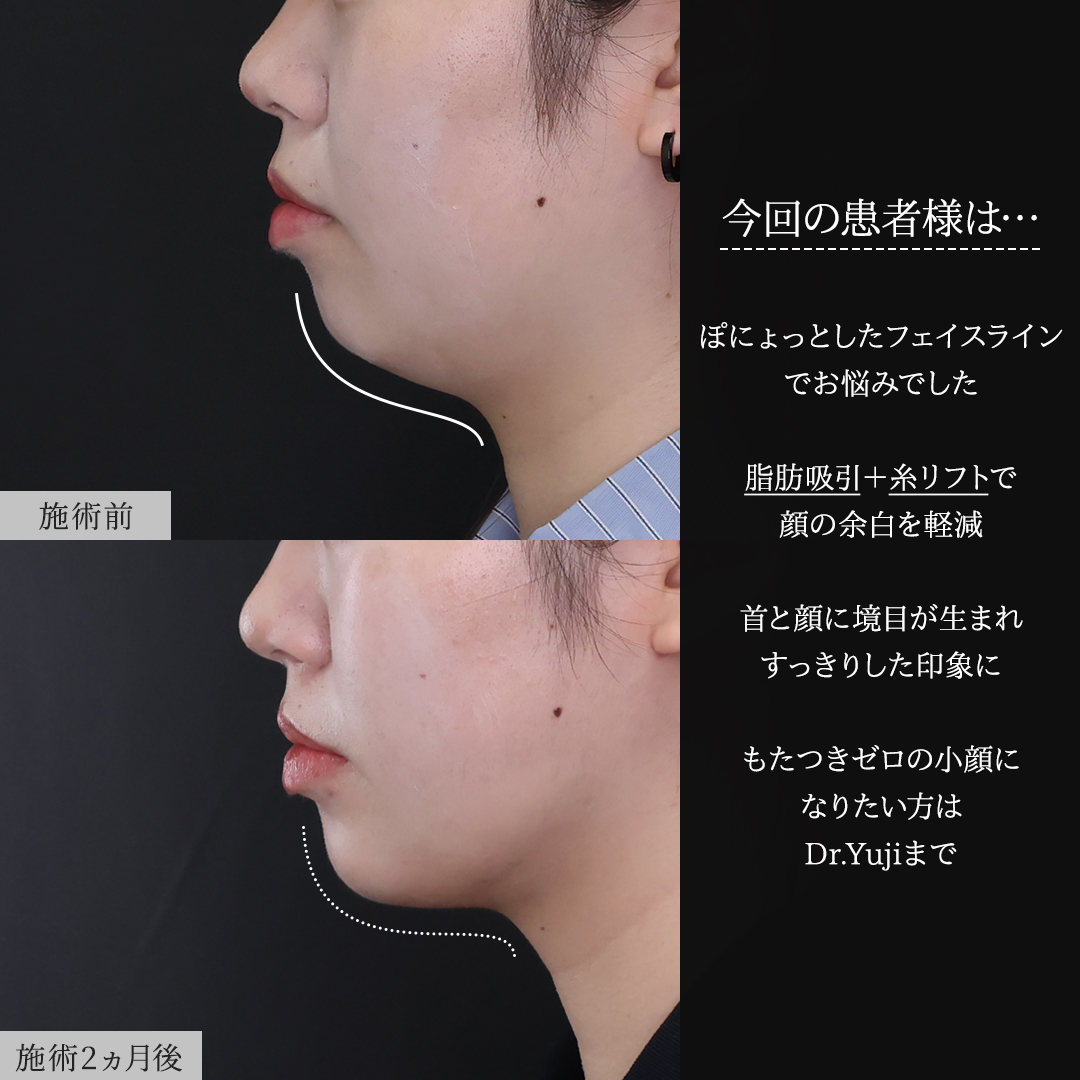 TAC式 ツヤ肌コラーゲンリフト®/顎下の脂肪吸引/ジョールファット除去の症例写真 施術前後 