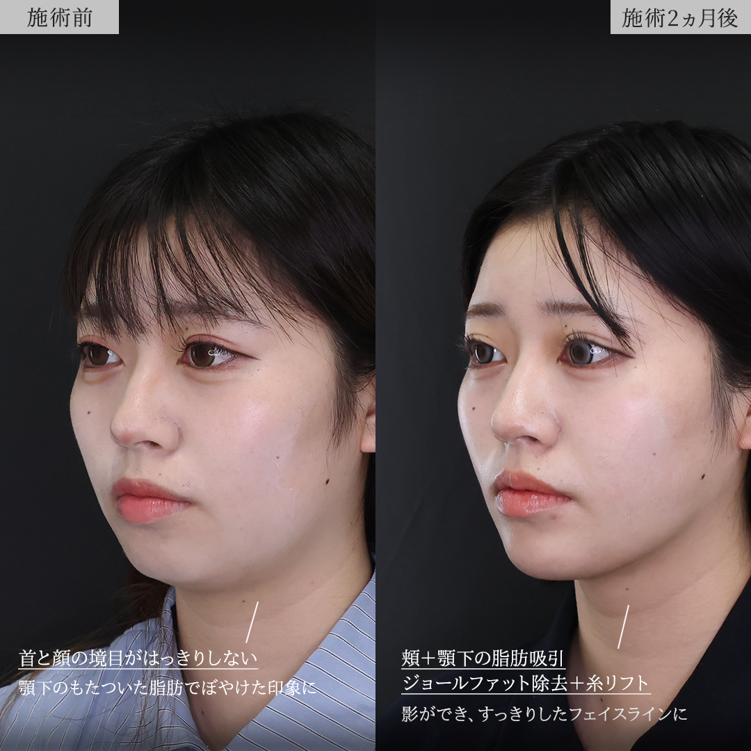 TAC式 ツヤ肌コラーゲンリフト®/顎下の脂肪吸引/ジョールファット除去の症例写真 施術前後 