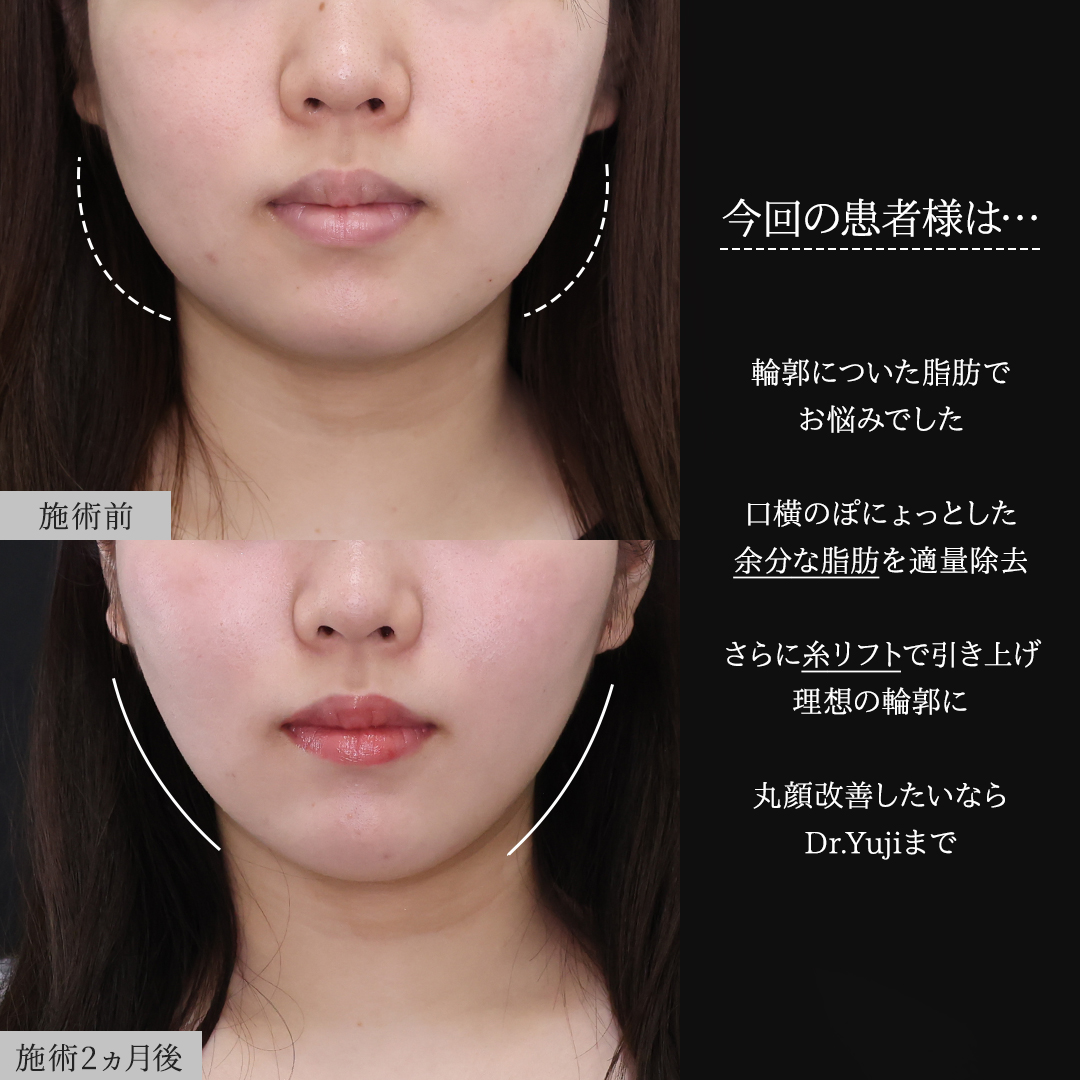 TAC式 ツヤ肌コラーゲンリフト®/ジョールファット除去/Lラインファット除去（エラ下脂肪除去）の症例写真 施術前後 