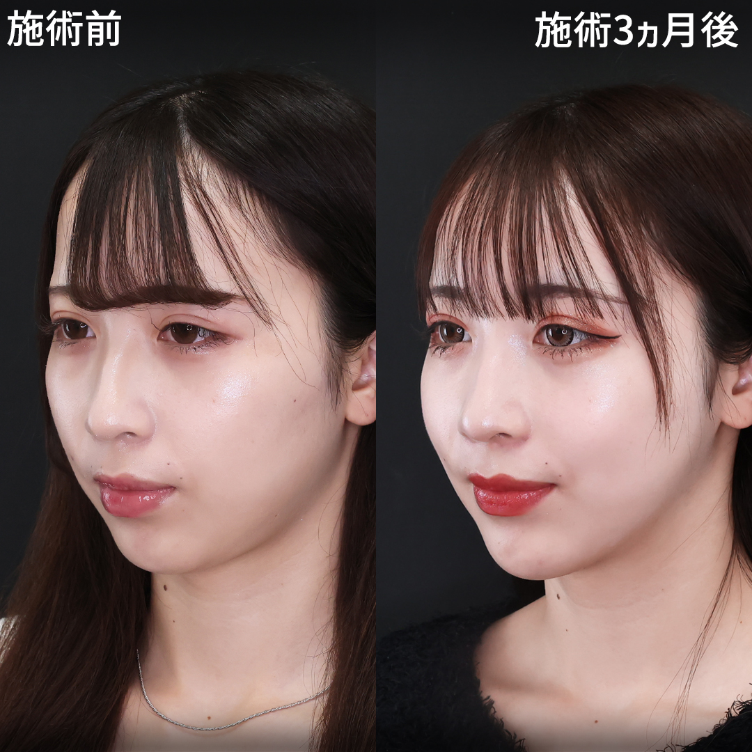 根こそぎ吸って輪郭出現！垢抜け小顔革命