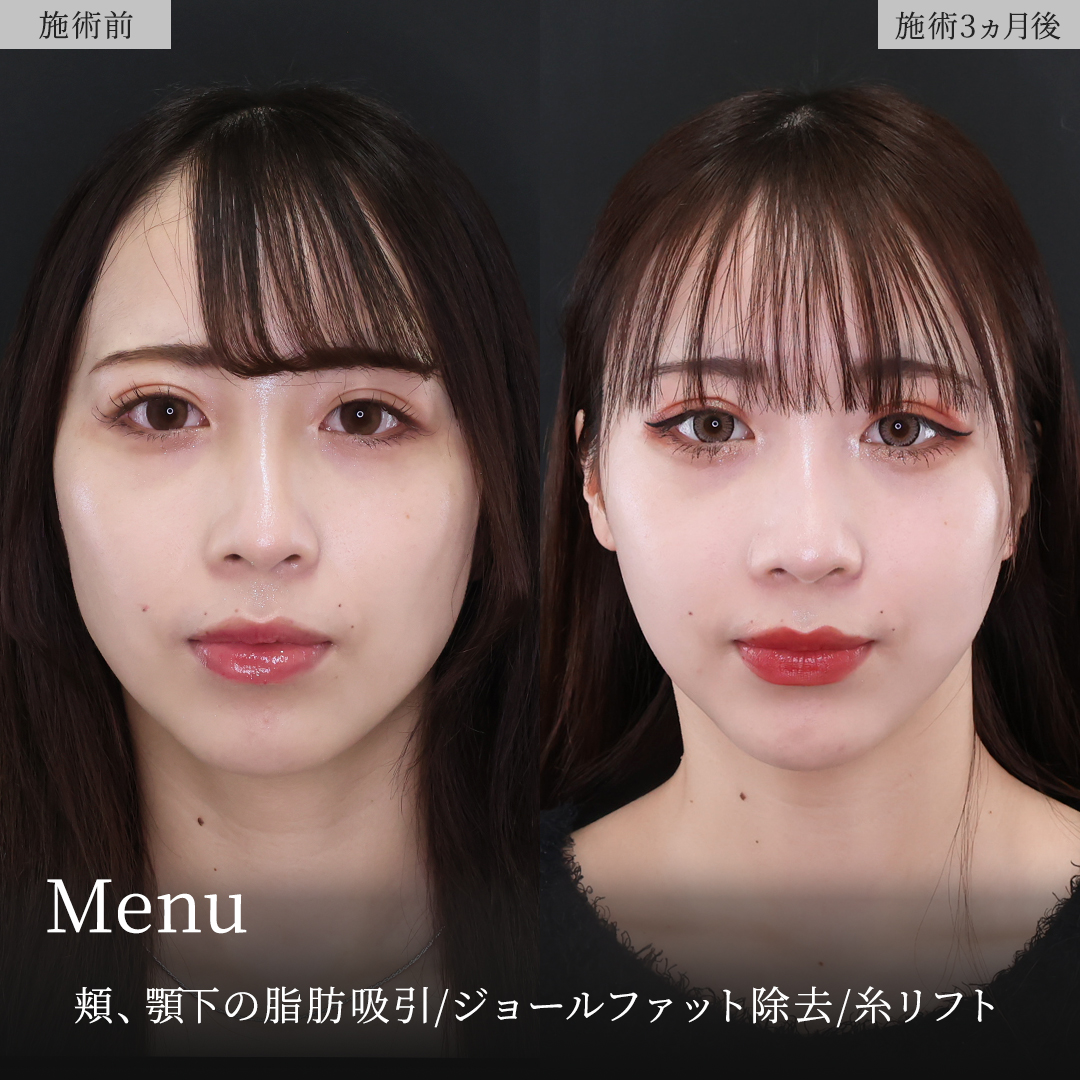 TAC式 ツヤ肌コラーゲンリフト®/顎下の脂肪吸引/ジョールファット除去の症例写真 施術前後 