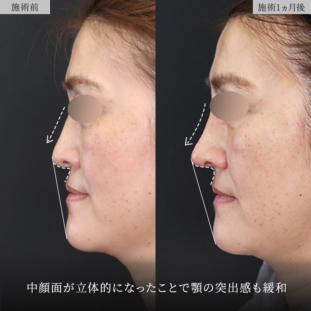 鼻中隔延長術/鼻尖形成・鼻尖縮小/鼻先軟骨移植の症例写真 施術前後 