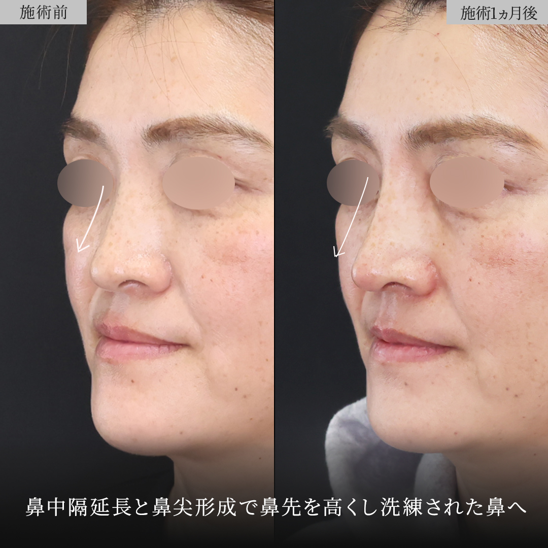 鼻中隔延長術/鼻尖形成・鼻尖縮小/鼻先軟骨移植の症例写真 施術前後 