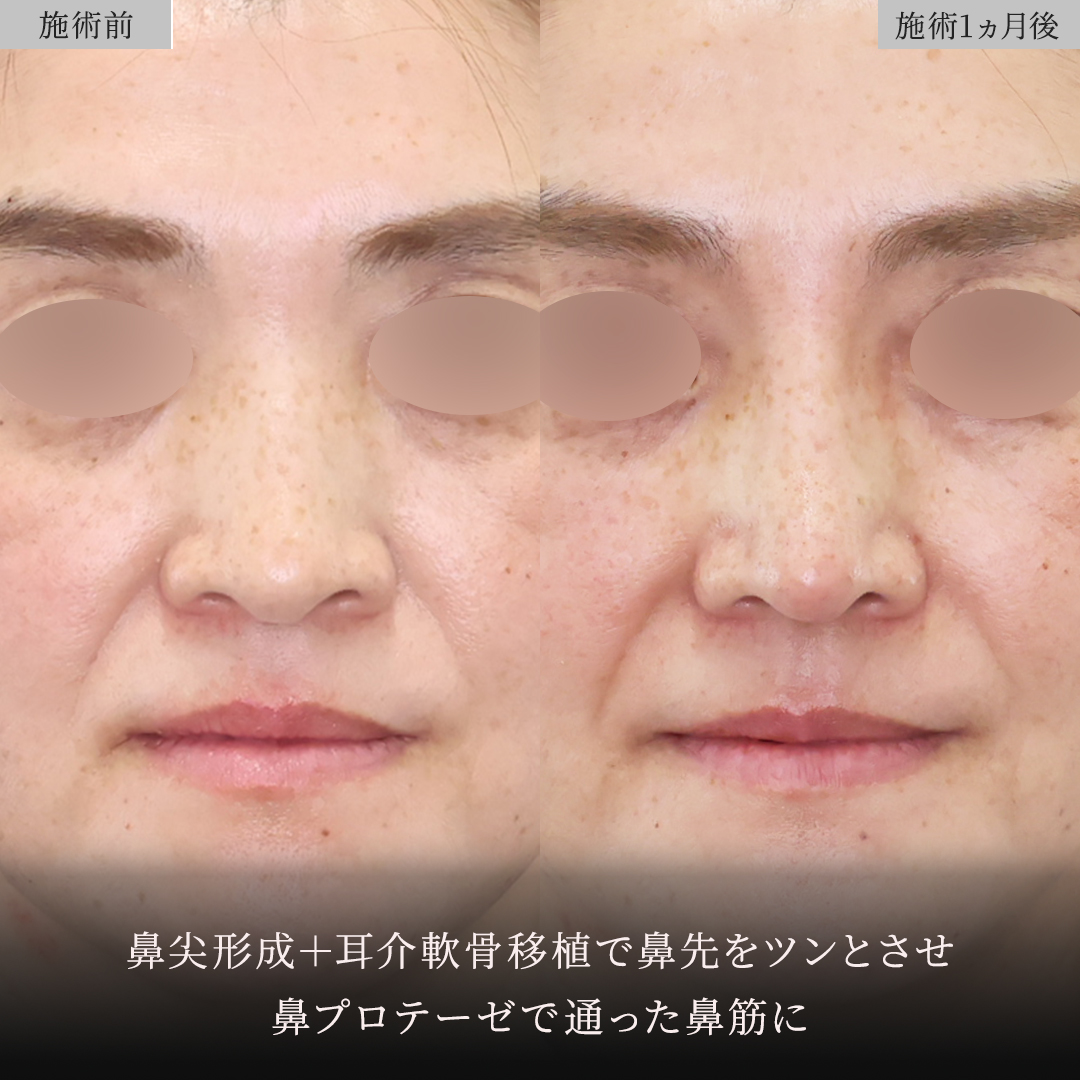 鼻中隔延長術/鼻尖形成・鼻尖縮小/鼻先軟骨移植の症例写真 施術前後 