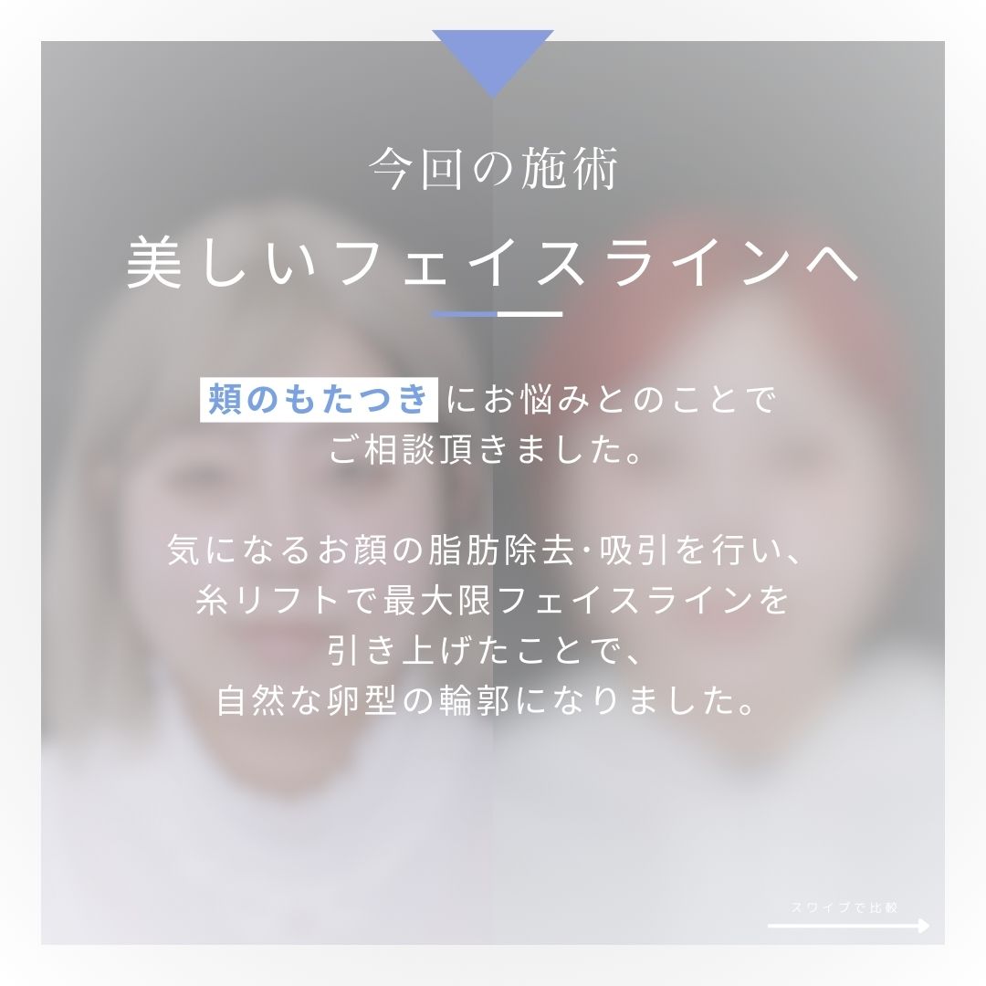 TAC式 ツヤ肌コラーゲンリフト®/ジョールファット除去/Lラインファット除去(エラ下脂肪除去)の症例写真 施術前後