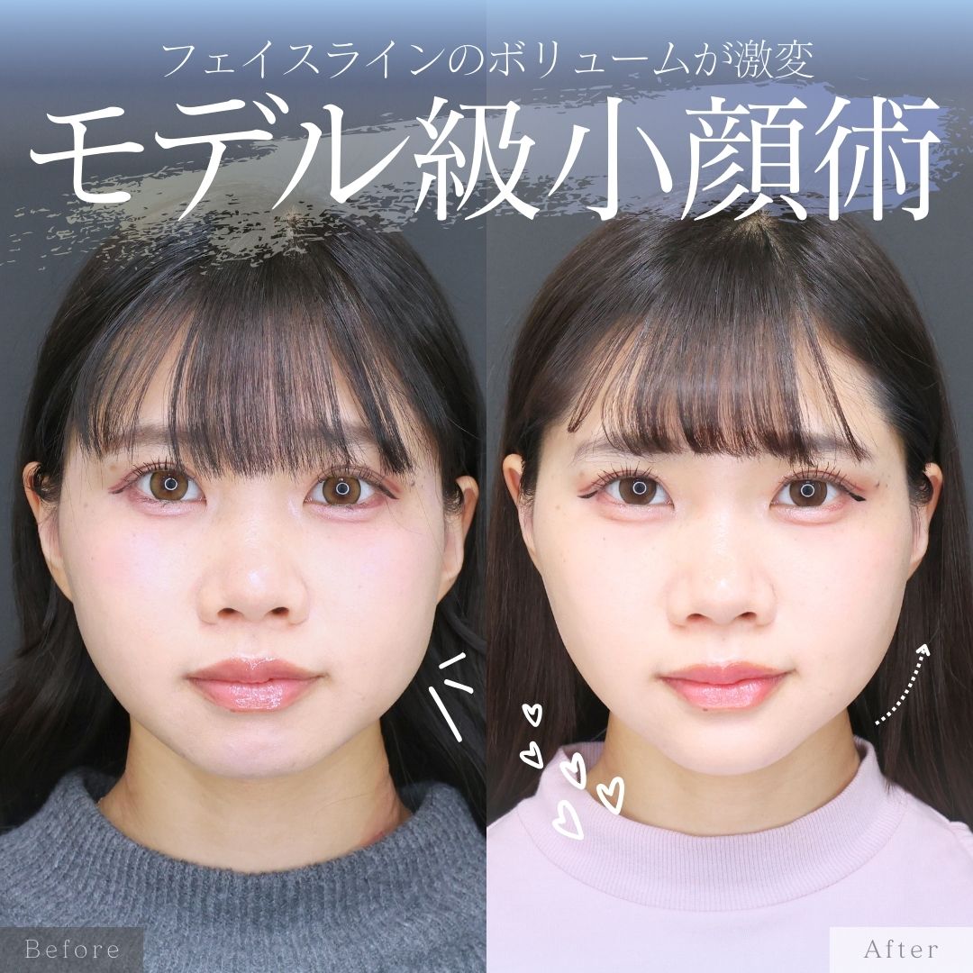 TAC式 ツヤ肌コラーゲンリフト®/顎のヒアルロン酸注射/エラボトックス注射の症例写真 施術前後 