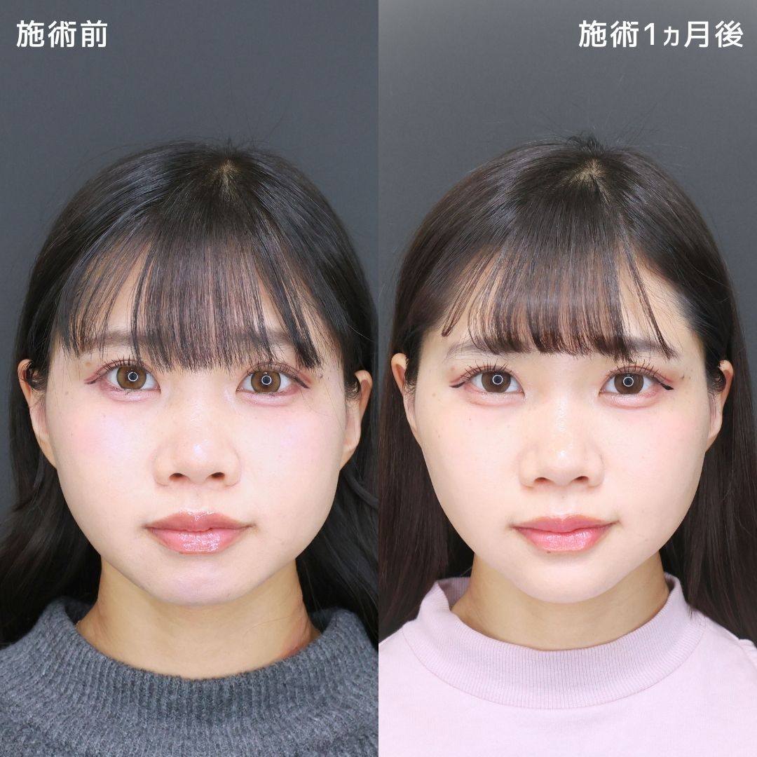 【かわいいをアップデート！】フェイスラインのボリュームが激変！！