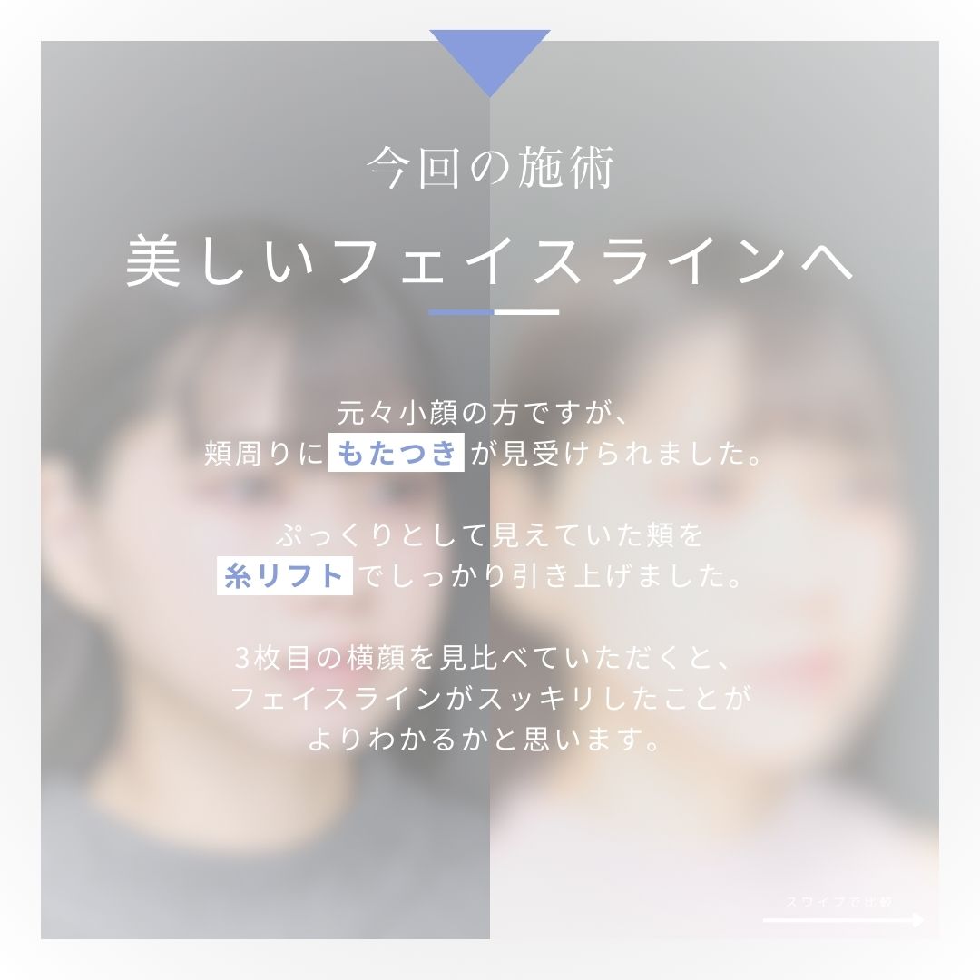 TAC式 ツヤ肌コラーゲンリフト®/顎のヒアルロン酸注射/エラボトックス注射の症例写真 施術前後 