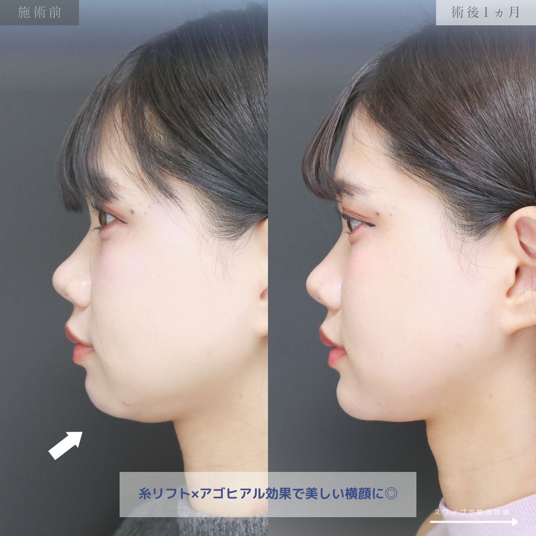 TAC式 ツヤ肌コラーゲンリフト®/顎のヒアルロン酸注射/エラボトックス注射の症例写真 施術前後 