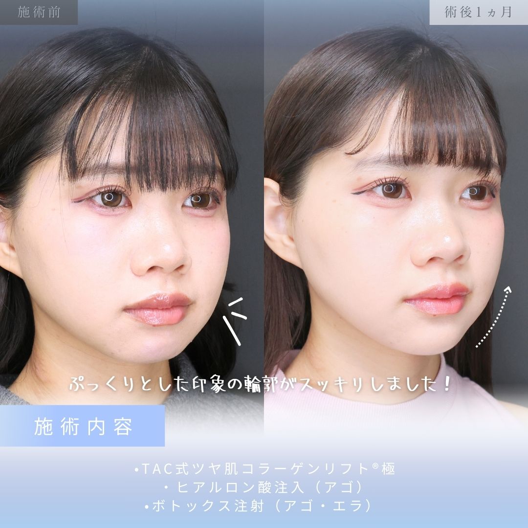 TAC式 ツヤ肌コラーゲンリフト®/顎のヒアルロン酸注射/エラボトックス注射の症例写真 施術前後 