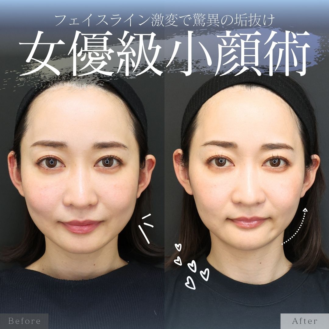 TAC式 ツヤ肌コラーゲンリフト®/エラボトックス注射/ボトックス注射：その他の症例写真 施術前後 