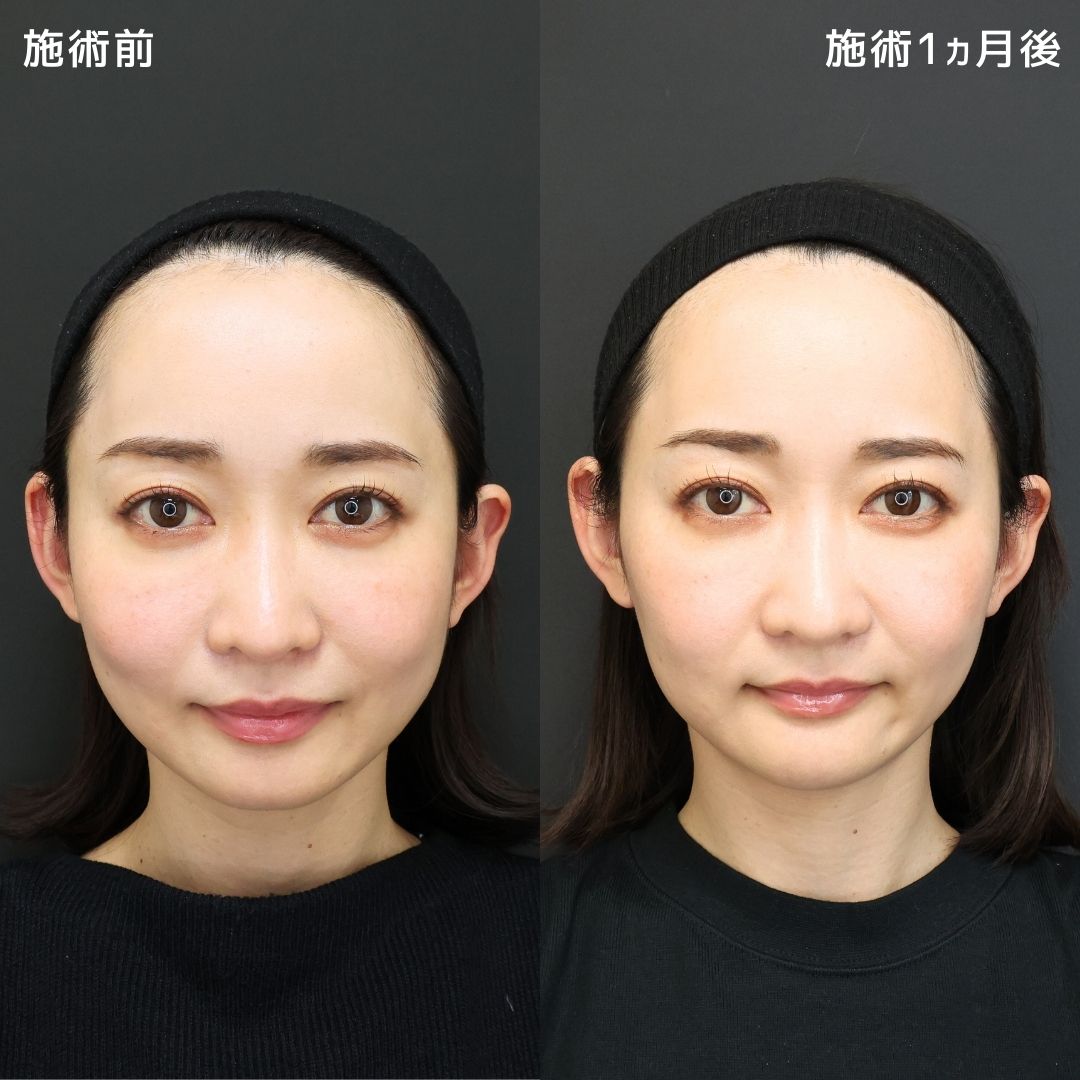 《小顔整形》お顔のバランスは足し算(ヒアルロン酸)とかけ算(糸リフト)で解決