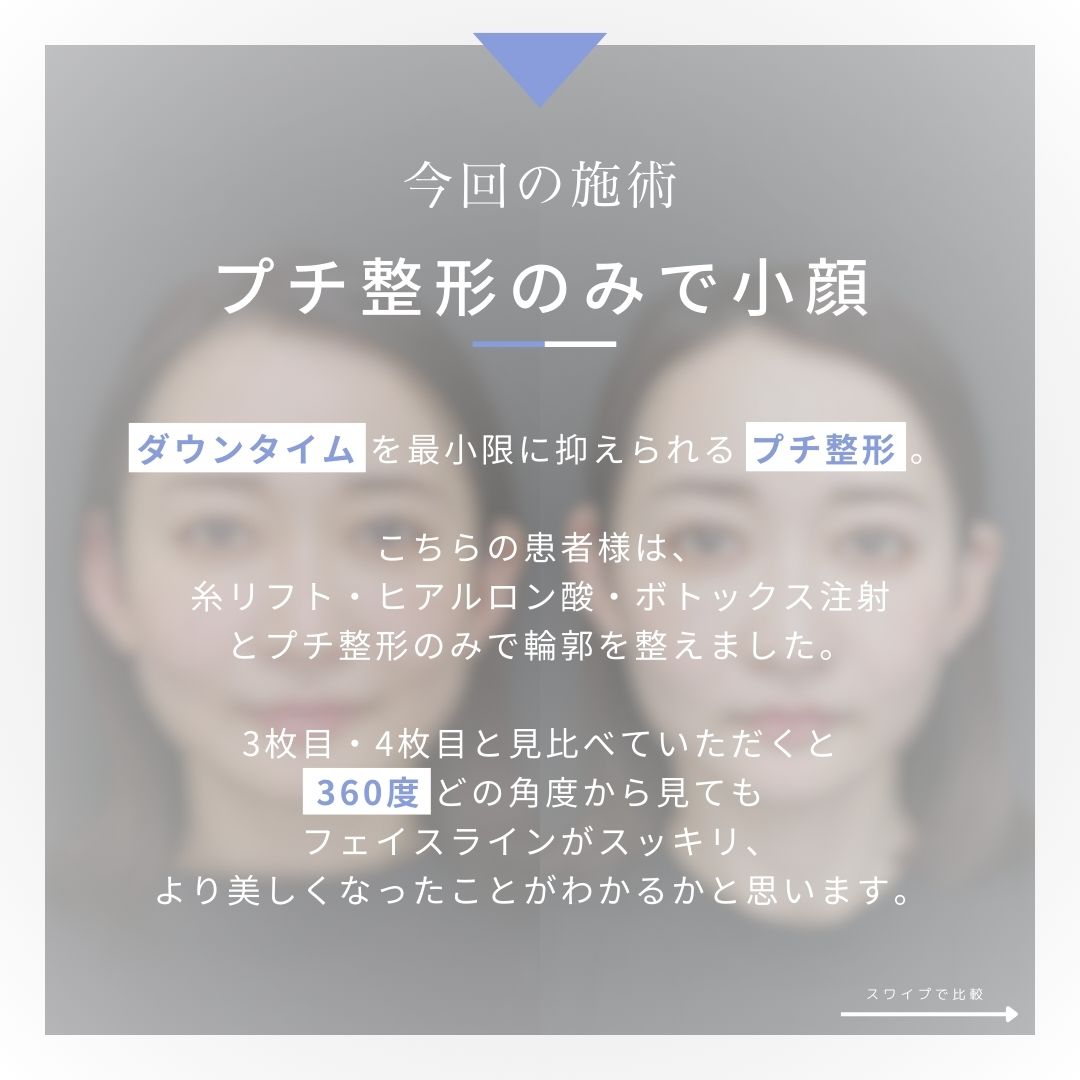 TAC式 ツヤ肌コラーゲンリフト®/エラボトックス注射/ボトックス注射：その他の症例写真 施術前後 