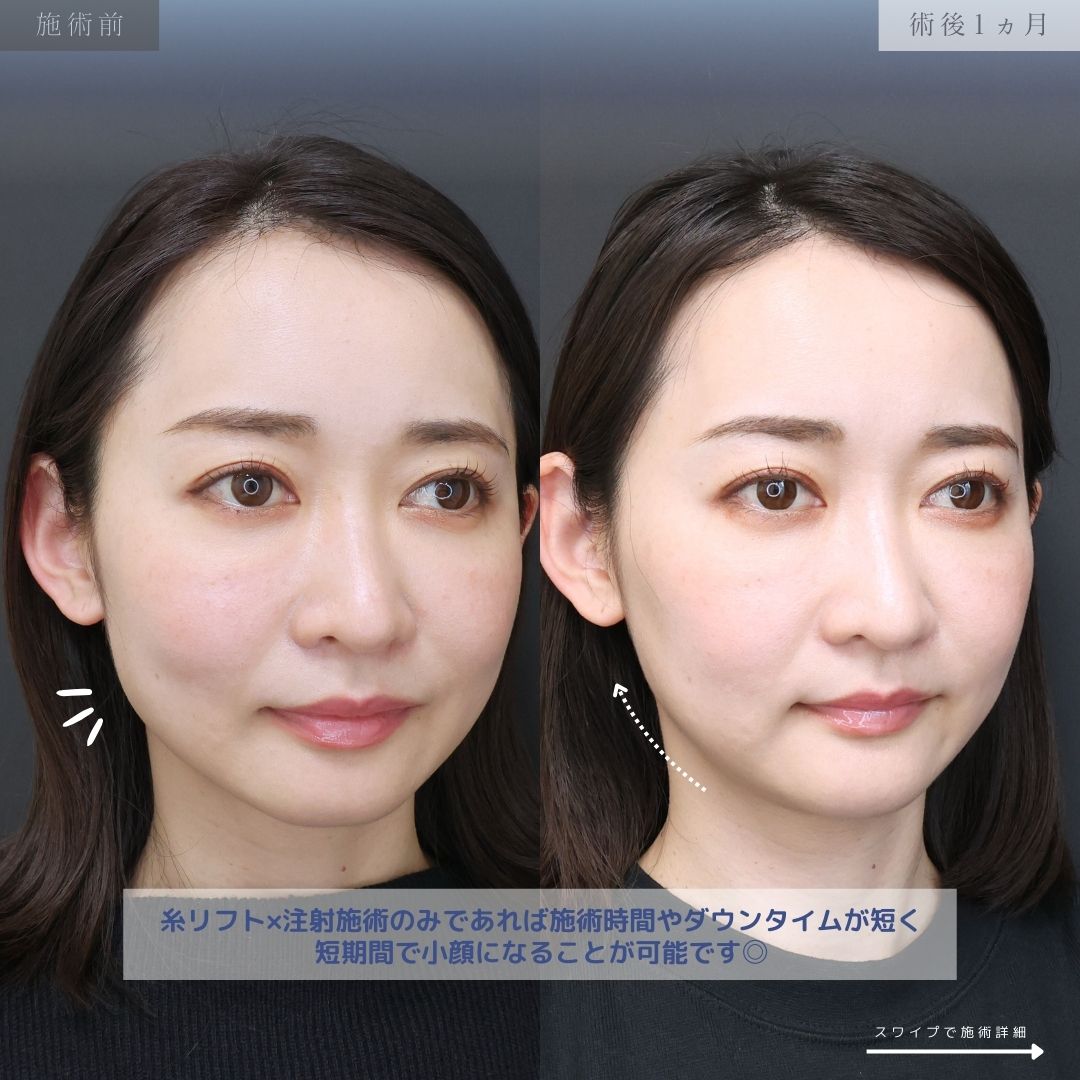 TAC式 ツヤ肌コラーゲンリフト®/エラボトックス注射/ボトックス注射：その他の症例写真 施術前後 