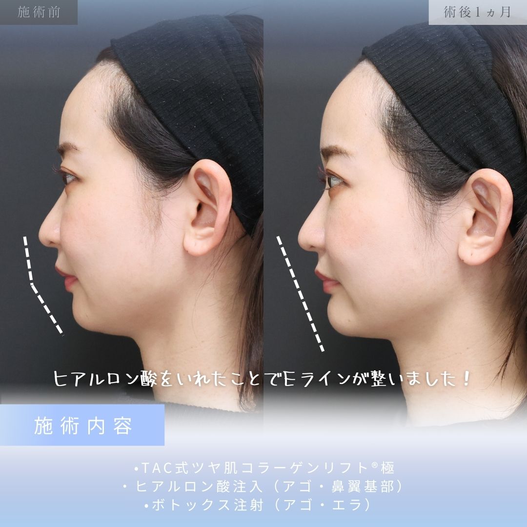 TAC式 ツヤ肌コラーゲンリフト®/エラボトックス注射/ボトックス注射：その他の症例写真 施術前後 
