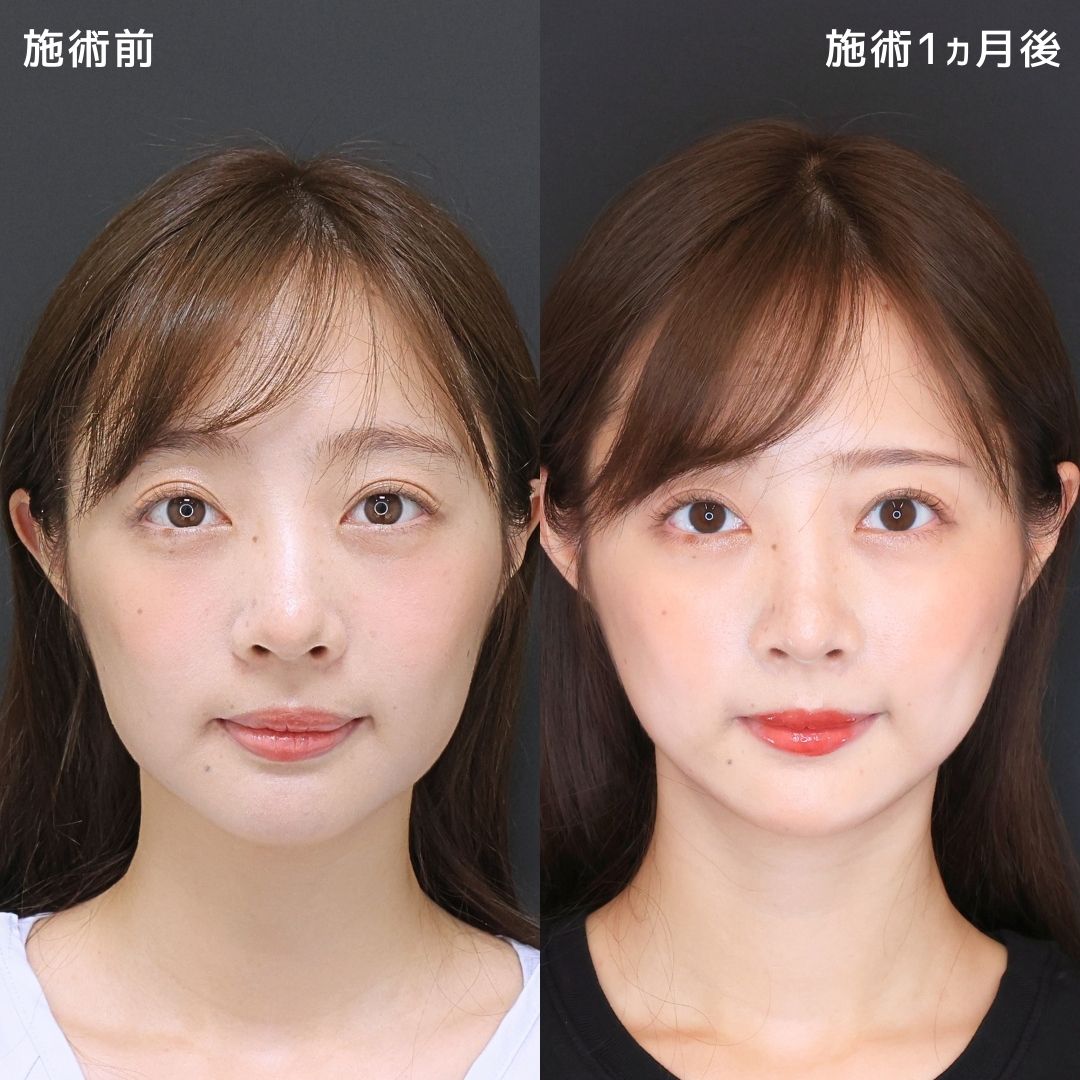 《堂脇副院長による》糸リフトで綺麗をさらにアップデート